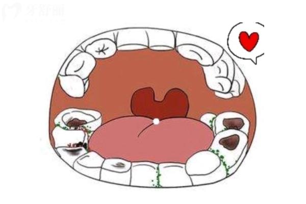 蛀牙不疼也要補是過度醫(yī)療嗎？