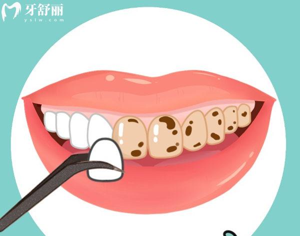 2025北京牙齒貼面的價(jià)格是多少