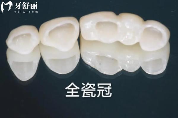 上海全瓷牙冠多少錢一顆
