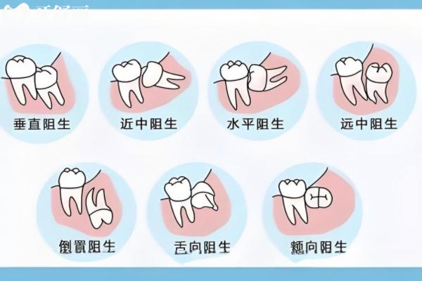 深圳拔一顆智齒需要多少錢？
