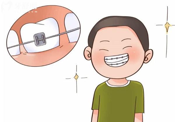 沈陽(yáng)牙齒矯正價(jià)格全攻略