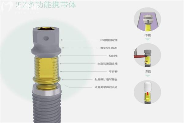 鄭州種植牙價格表查詢:種植體一顆低至1680元起附種牙技術(shù)口碑好的口腔門診