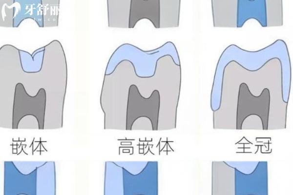 重慶補(bǔ)牙多少錢(qián)一顆？