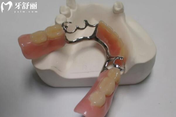北**腔鑲牙多少錢(qián)一顆價(jià)格表:活動(dòng)假牙