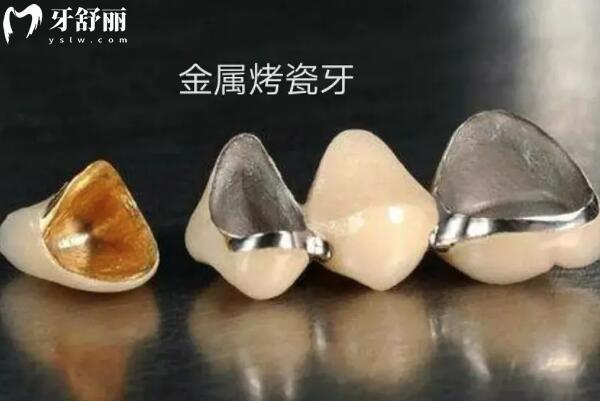 2025宜賓喜牙口腔收費標準調(diào)整:種牙2960元起、鑲牙680元起、拔牙80元起
