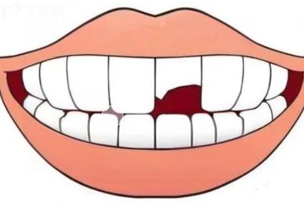 粘接橋修復(fù)優(yōu)缺點(diǎn)有哪些