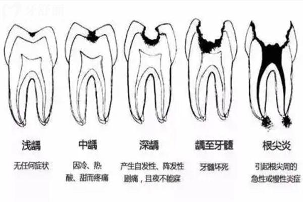 怎么判斷齲齒齲壞程度?齲齒一度到五度圖片照片大全真實分享