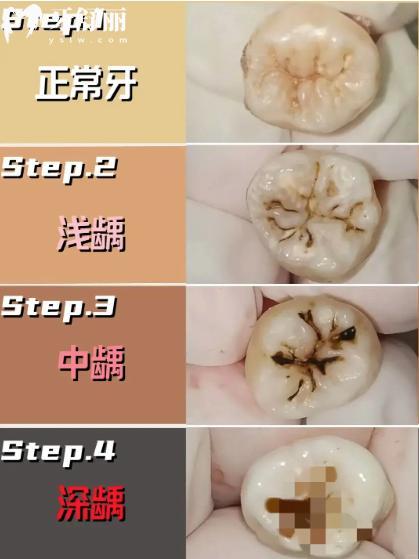怎么判斷齲齒齲壞程度?齲齒一度到五度圖片照片大全真實分享