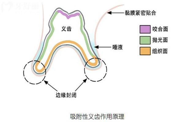 吸附式假牙費(fèi)用價(jià)格一覽表:全口假牙約1-3w元不等相關(guān)佩戴原理及適合人群了解下