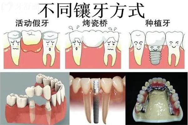 國(guó)內(nèi)正規(guī)牙科診所鑲牙價(jià)格明細(xì)表:牙冠600+活動(dòng)假牙3k+吸附性牙1.5w+種植牙3w+