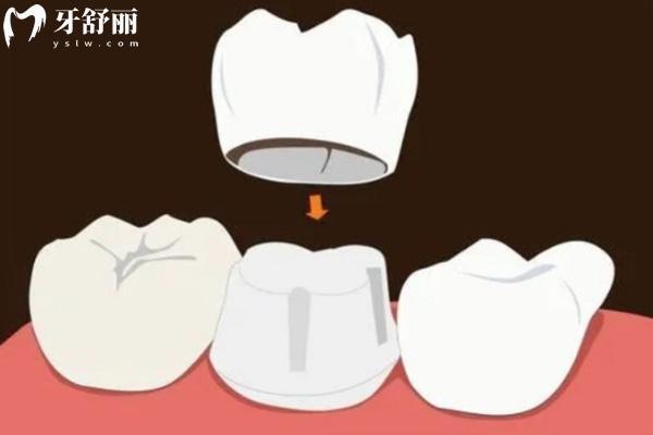國(guó)內(nèi)正規(guī)牙科診所鑲牙價(jià)格明細(xì)表:牙冠600+活動(dòng)假牙3k+吸附性牙1.5w+種植牙3w+
