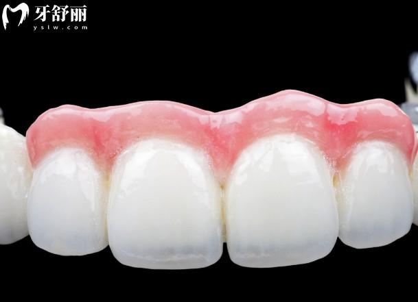 德國(guó)吉爾巴赫全瓷牙怎么樣?從牙冠的材質(zhì)/硬度/優(yōu)點(diǎn)/價(jià)格/使用壽命等深度解析