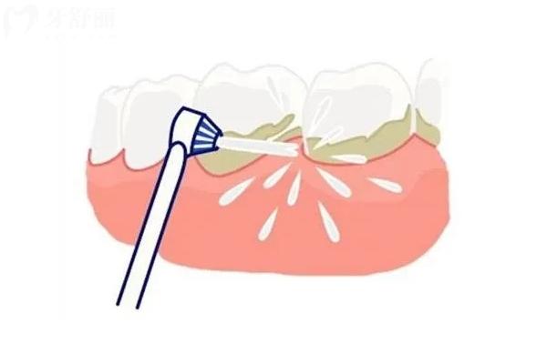 牙周刮治是什么意思？對(duì)牙周組織的深度清潔和治療手段（點(diǎn)擊查看詳情）