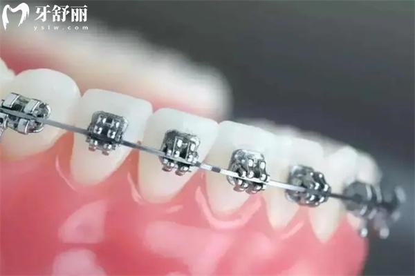 牙齒矯正多少錢2025價格表:矯正牙收費(fèi)價目表詳細(xì)包含金屬/陶瓷/隱形全系列價格