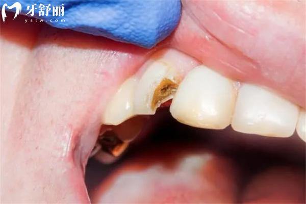 門牙磕掉一小塊怎么補(bǔ)?門牙缺損不同程度的修復(fù)方法有哪些快來了解!