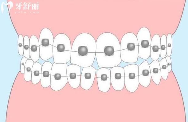 成都牙齒矯正價格表2025公開:暑期學(xué)生矯正優(yōu)惠力度大,收費透明口碑佳