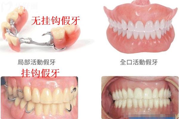 裝半口假牙有幾種方法?活動(dòng)牙/固定牙究竟哪種好對(duì)比材料及價(jià)格表來(lái)看看吧