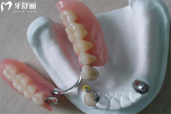 裝半口假牙有幾種方法?活動(dòng)牙/固定牙究竟哪種好對(duì)比材料及價(jià)格表來(lái)看看吧