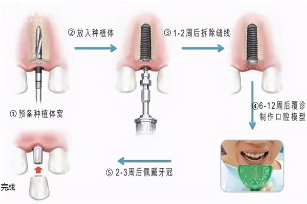 裝半口假牙有幾種方法?活動(dòng)牙/固定牙究竟哪種好對(duì)比材料及價(jià)格表來(lái)看看吧