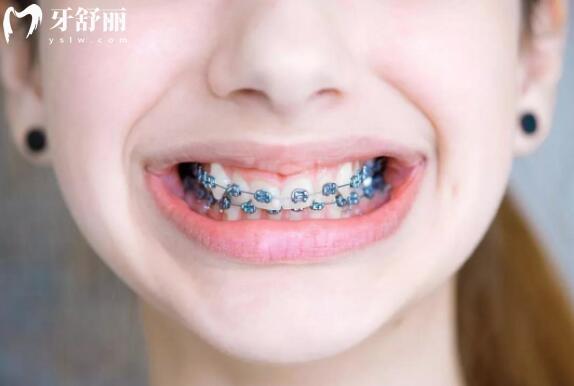 舌側(cè)矯正和傳統(tǒng)矯正哪個成果好?矯正成果