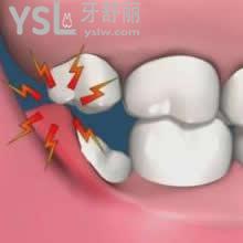 拔掉智齒有什么危害！