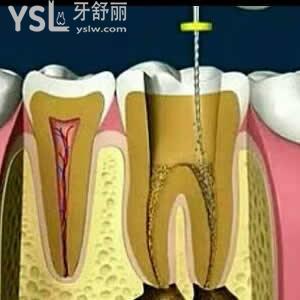 做根管治療到底疼不疼，我從來還沒有做過！