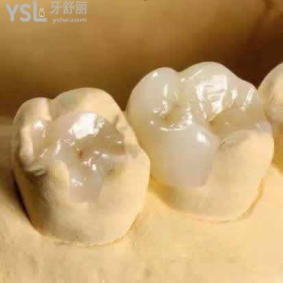 廈門(mén)登特口腔義獲嘉E.max press鑄瓷嵌體多少錢(qián)？