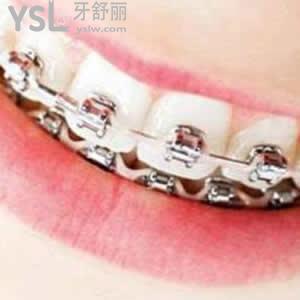 天津中諾口腔好不好？金屬托槽矯正價(jià)格超低優(yōu)惠新年大紅包奉上！