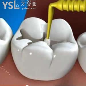 北京維樂口腔成人3m樹脂補(bǔ)牙價格