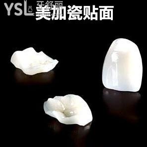 南寧柏樂口腔美加瓷貼面收費價格怎么樣？