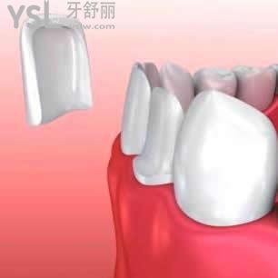 深圳正夫口腔美學牙齒瓷貼面多少錢一顆