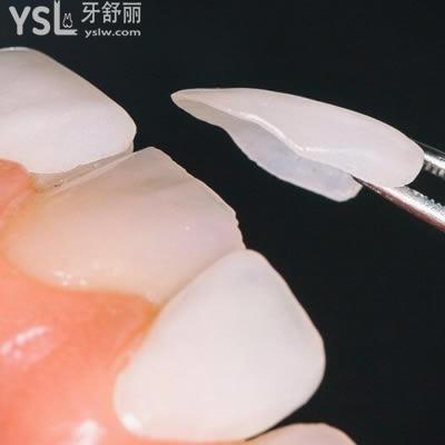 包頭植諾口腔怎么樣？包頭植諾口腔超薄瓷貼面價格貴嗎？
