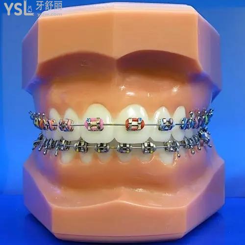 蘭州皓亞口腔牙齒矯正（傳統(tǒng)托槽）多少錢？