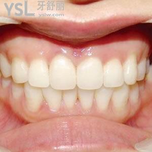 上海悅康口腔坑人嗎？全瓷牙價(jià)格有活動(dòng)好劃算。