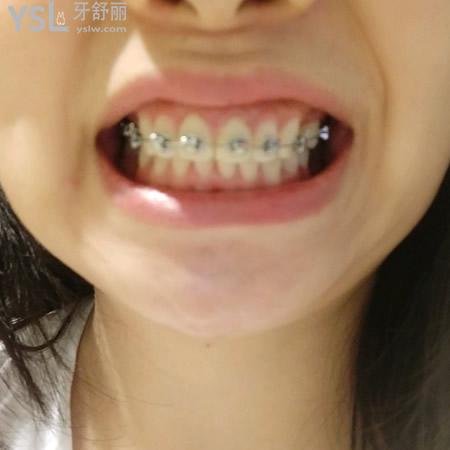 沈陽(yáng)盛大口腔醫(yī)院牙齒矯正（自鎖托槽）多少錢？