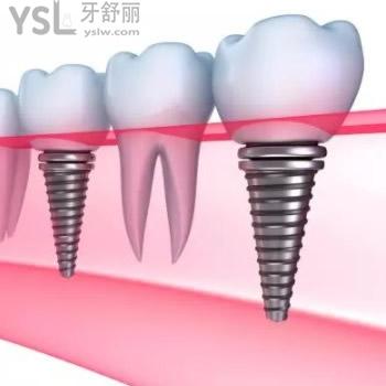 沈陽盛大口腔韓國進(jìn)口植體全包價(jià)格表