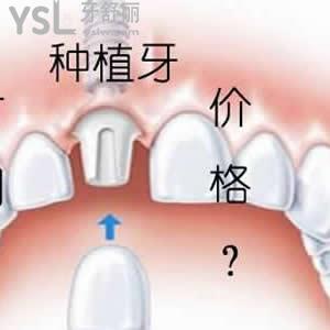天津美奧口腔貴嗎？可以參考下進口種植牙收費如何。
