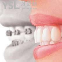 杭州美奧口腔牙齒矯正收費多少錢？