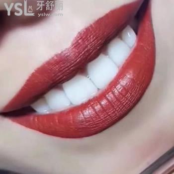 西安諾貝爾牙科義獲嘉e-max瓷貼面單顆多少錢？