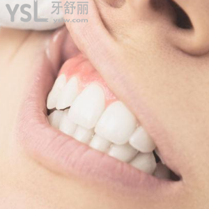 成都圣貝牙科醫(yī)院價(jià)格表之時(shí)代天使隱形矯正優(yōu)惠來嘍！