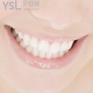 深圳富華醫(yī)院口腔科收費(fèi)標(biāo)準(zhǔn)之鈷鉻合金烤瓷冠多少錢(qián)？
