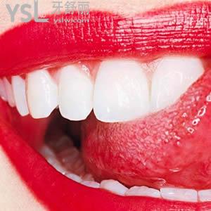 深圳富華醫(yī)院口腔科瓷貼面（E-MAX）多少錢？