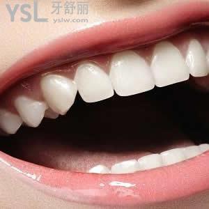 廣州圣貝口腔樹(shù)脂補(bǔ)牙價(jià)格貴嗎？