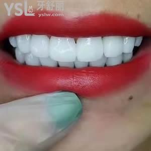 重慶成佳牙博士口腔醫(yī)院價(jià)格之全瓷貼面多少錢？