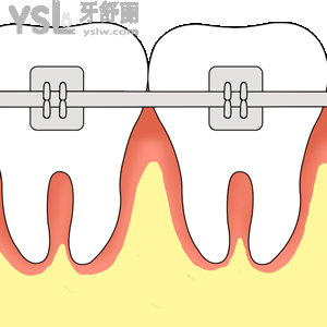 鄭州拜博口腔醫(yī)院牙齒矯正美國(guó)ORMCO（金屬）活動(dòng)收費(fèi)標(biāo)準(zhǔn)