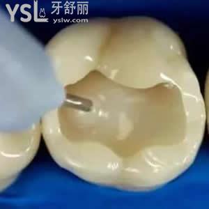珠海九龍口腔醫(yī)院價(jià)格貴嗎？進(jìn)口3M納米樹脂補(bǔ)牙價(jià)格優(yōu)惠。