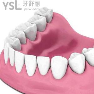 鑲一顆假牙一般需要多少錢？