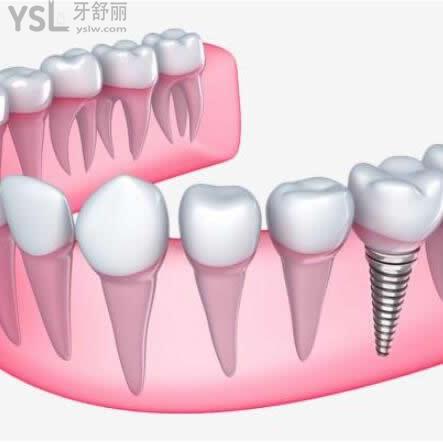 西安海濤口腔醫(yī)院種植牙怎么樣,多少錢(qián)一顆？