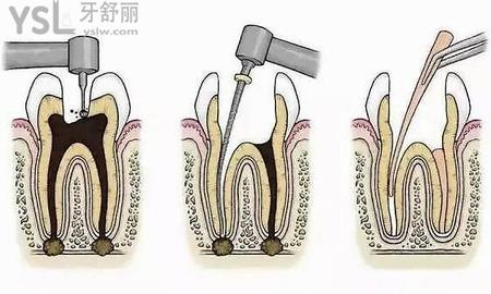 根管治療要多少錢(qián)？