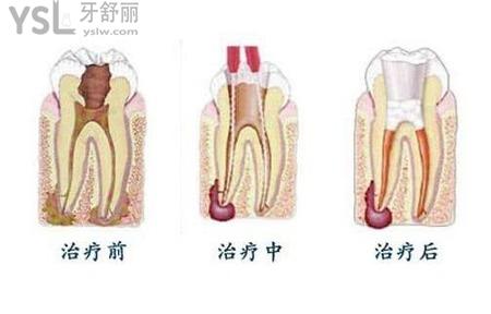 根管治療有什么注意事項(xiàng)？